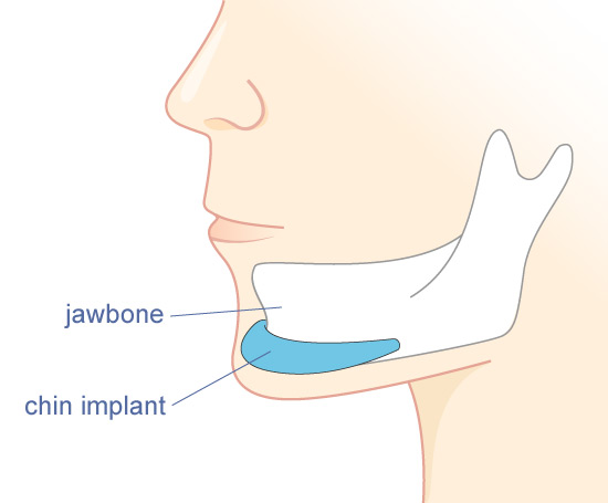 Khắc phục cằm lệch do độn cằm hỏng bằng cách nào?