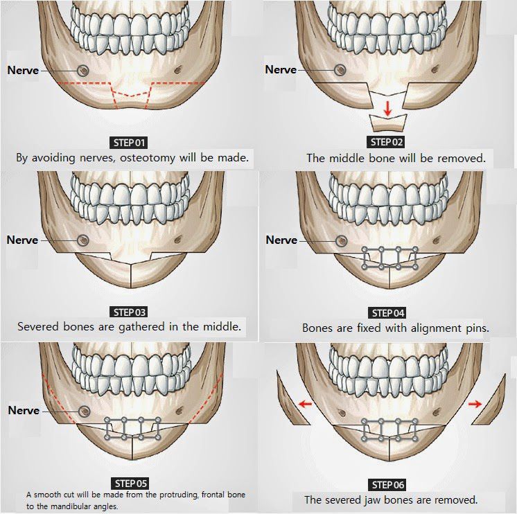 Khắc phục cằm lệch do độn cằm hỏng bằng cách nào?