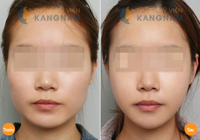 Sở hữu khuôn mặt trái xoan nhờ phẫu thuật độn cằm Hàn Quốc