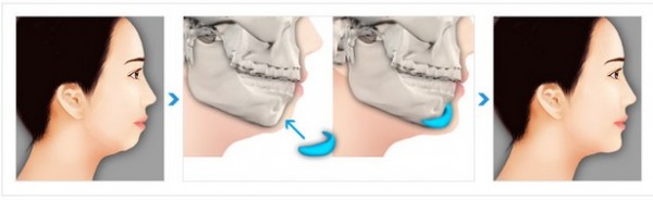 phẫu thuật thẩm mỹ độn cằm