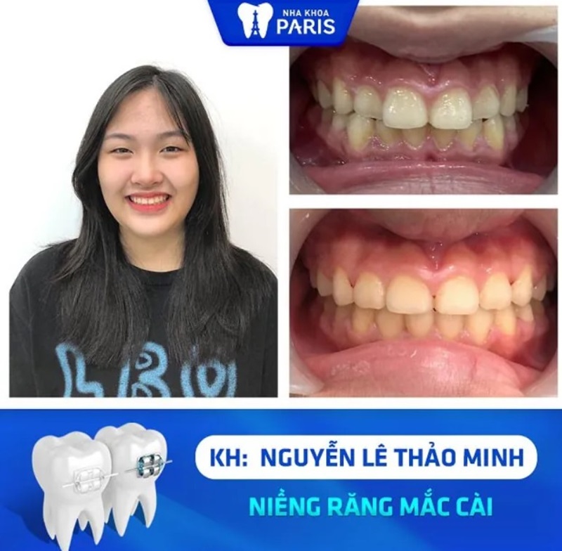 Khác hàng đánh giá tích cực sau khi niềng răng tại Paris
