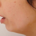 Biện pháp nào khắc phục cằm không cân đối an toàn nhất?