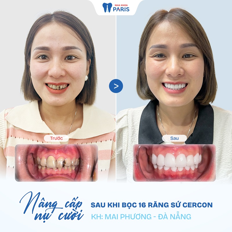 Khách hàng hài lòng khi bọc răng sứ tại cơ sở Paris Hải Phòng