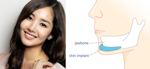 Cằm ngắn độn cằm có được không