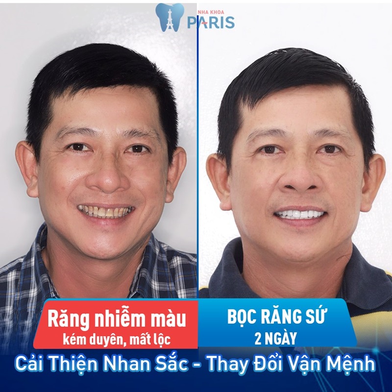 Hình ảnh khách hàng trước và sau khi bọc răng sứ ở Paris