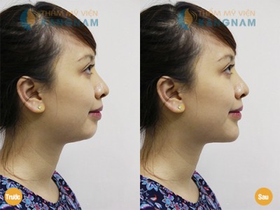 Kết quả sau phẫu thuật độn cằm ngắn 