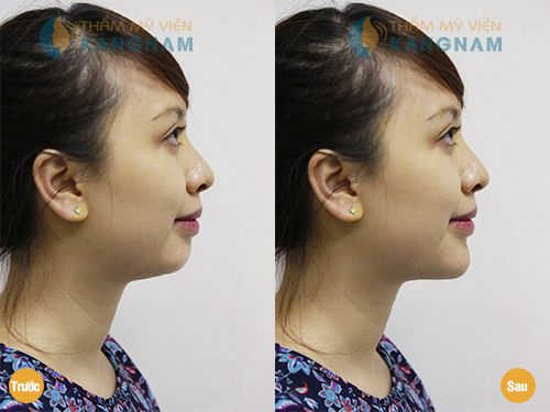 Độn cằm bây giờ để có cằm đẹp đón Tết 5