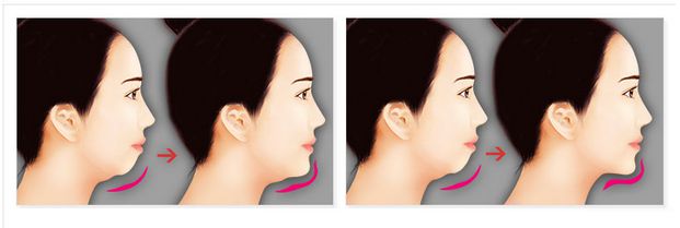 Độn cằm V-line có khắc phục được cằm ngắn, cằm lẹm?