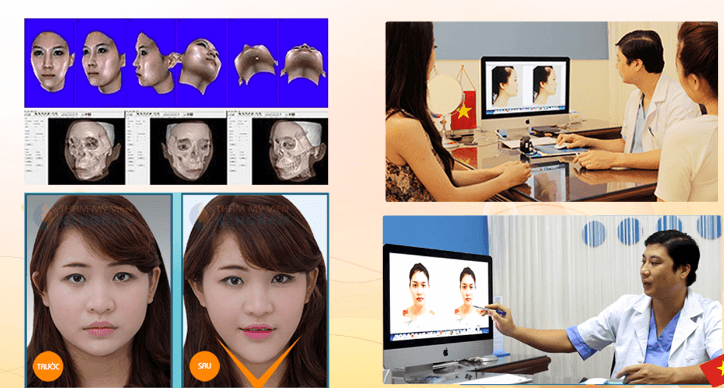 Giải pháp khắc phục khuyết điểm của chiếc cằm ngắn